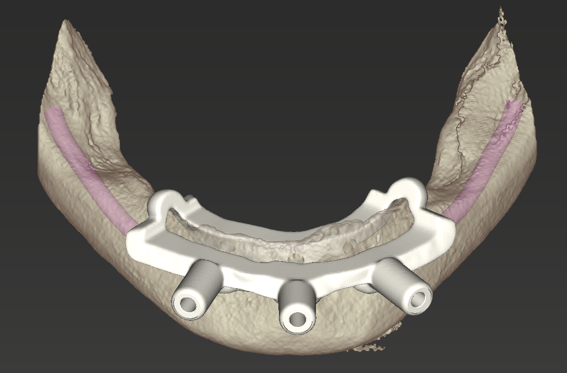 Simulated stackable bone-reduction guide