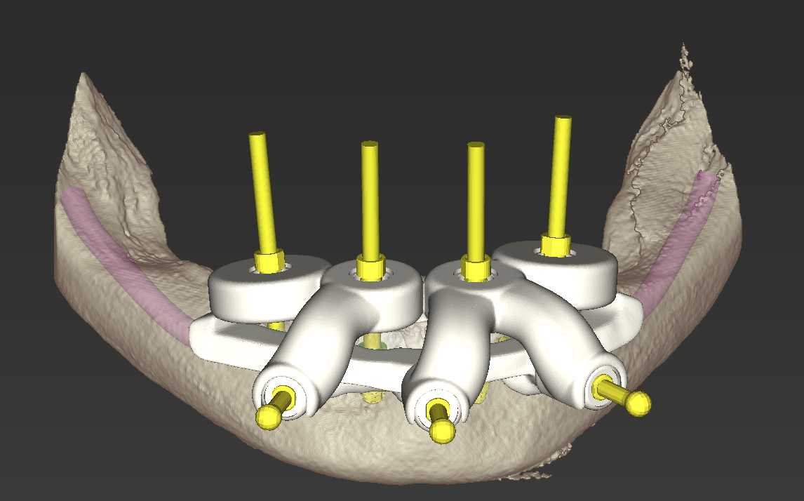 Simulated stackable surgical guide system