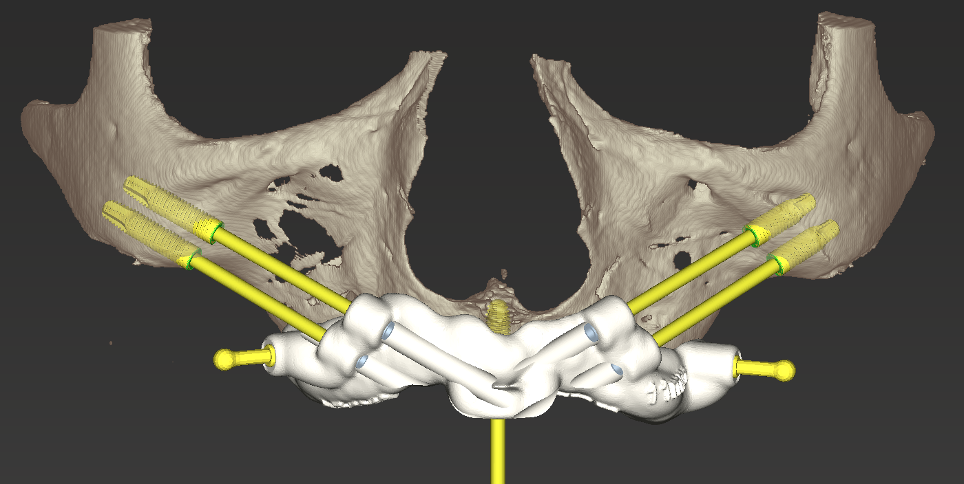 Simulated zygomatic implant guide and implant trajectories
